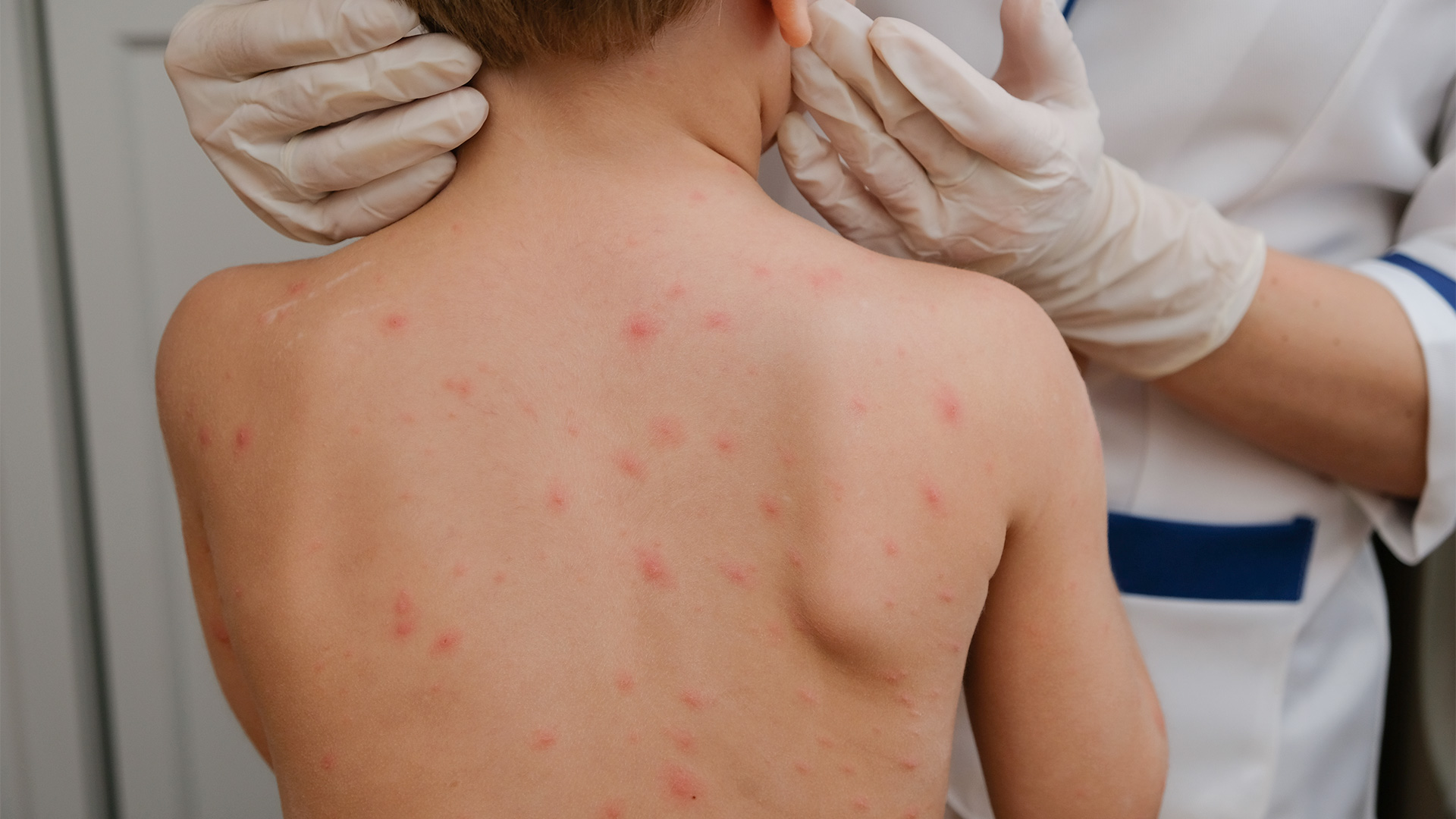 A UPA de Araguaína possui protocolo de atendimento para os casos suspeitos de sarampo e alerta a população sobre sintomas específicos para investigação e diagnóstico. (Foto: Freepik)